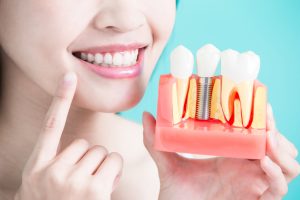 how to prepare for dental implant surgery