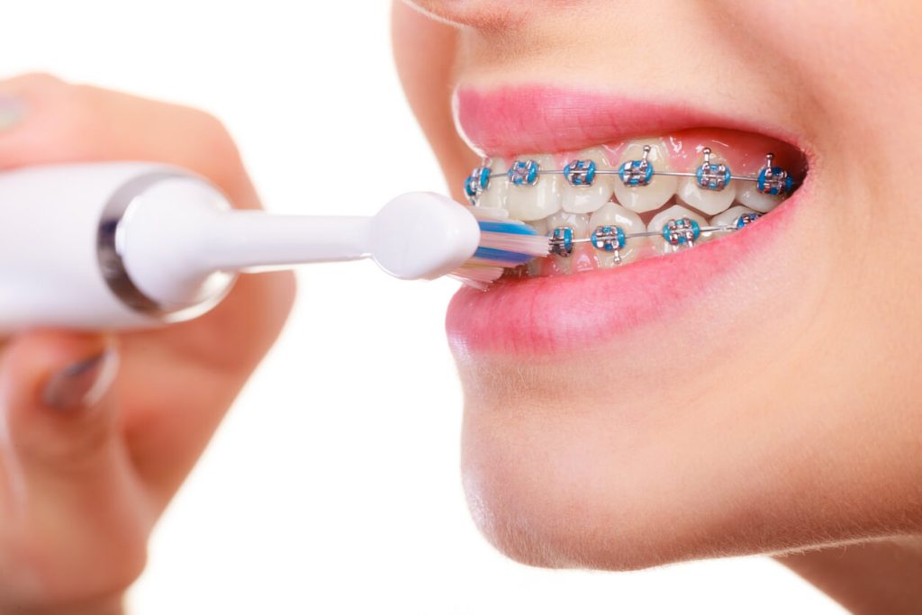 Young woman cleaning and brushing teeth with blue braces using toothbrush