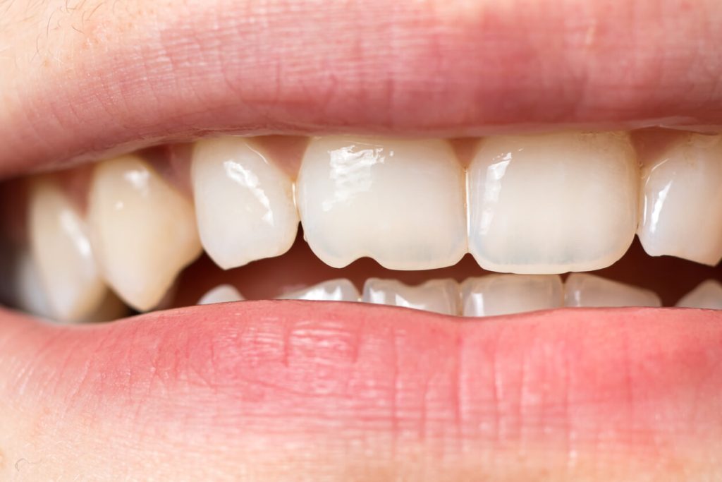 Is a chipped tooth an emergency?