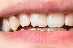 Is a chipped tooth an emergency?