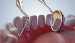 Importance of Periodontal Maintenance