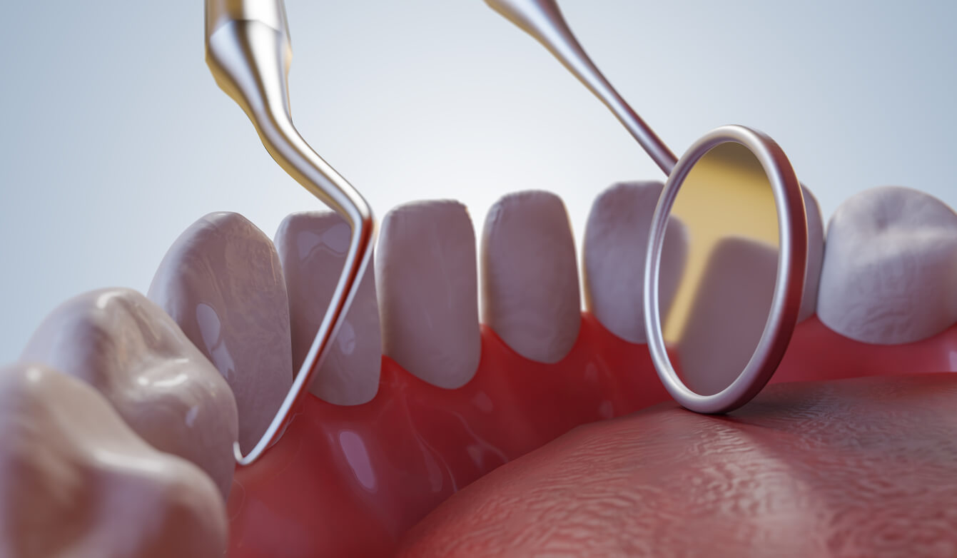 Importance of Periodontal Maintenance