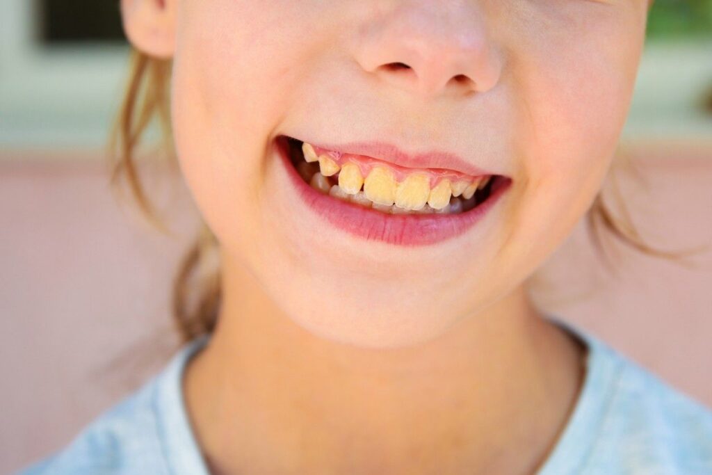 teeth feel chalky